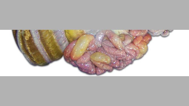 Obrzęk sieci i krezki jelit