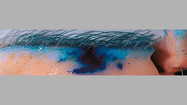 Needle-free injection technology improves the dispersion of vaccines throughout the tissue