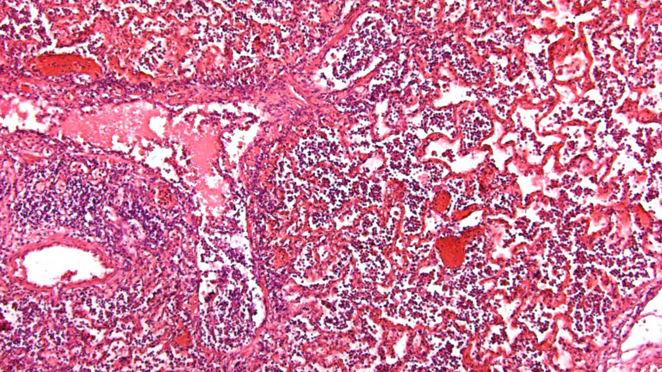 <p>Fot 5: Płyn w pęcherzykach i nagromadzenie kom&oacute;rek zapalnych.</p>
