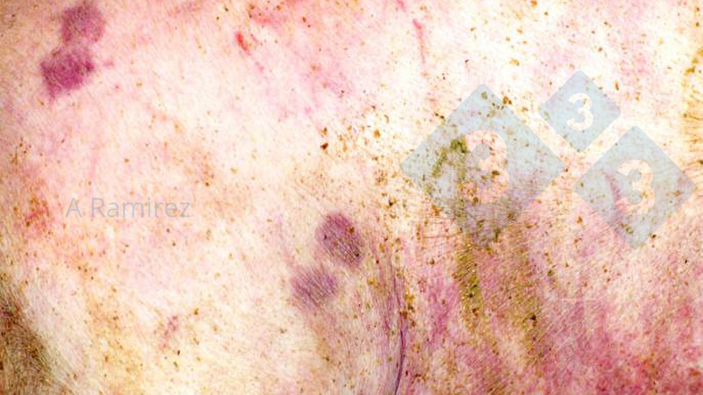 Fot. 1.&nbsp;Niemal patognomoniczna zmiana sk&oacute;rna w kształcie rombu.
