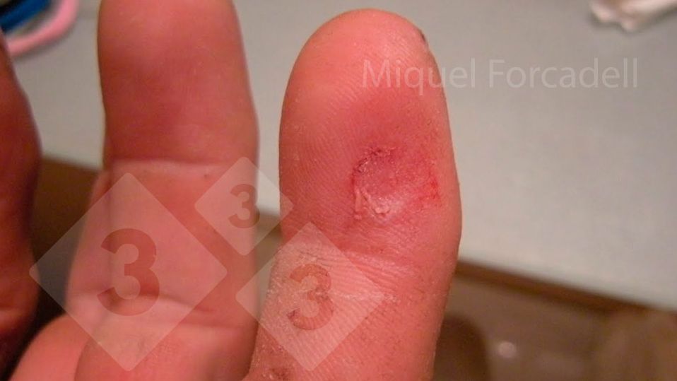 Małe, ostre zęby prosiąt mogą powodować te uciążliwe urazy palc&oacute;w pracownik&oacute;w podczas szlifowania zęb&oacute;w.
