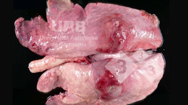 Fot.&nbsp;1. Wł&oacute;knikowo - martwicze zapalenie płuc odpowiadające &nbsp;zmianom wywoływanym przez App. Źr&oacute;dło: UAB.
