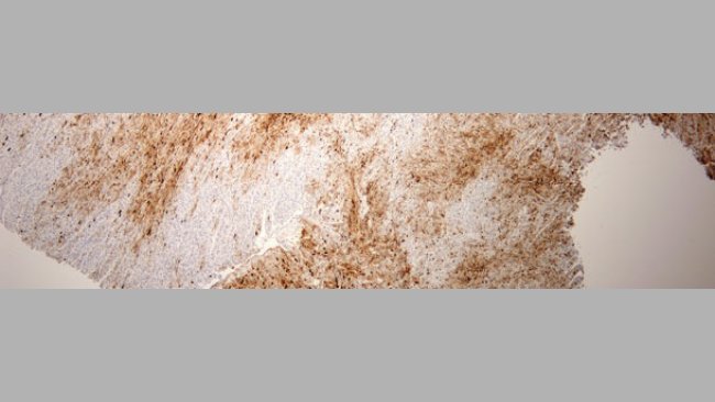 ciężkie uszkodzenie mięśnia sercowego z powodu PCV2