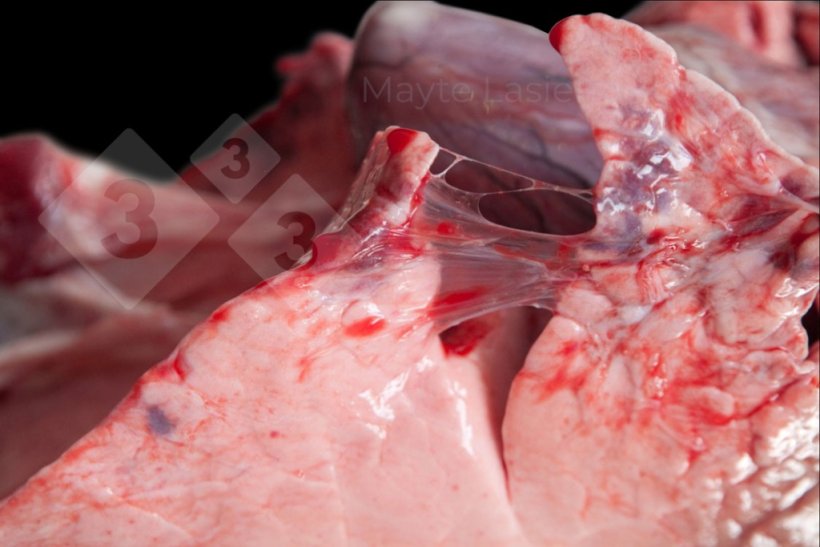 Zapalenie opłucnej doczaszkowej