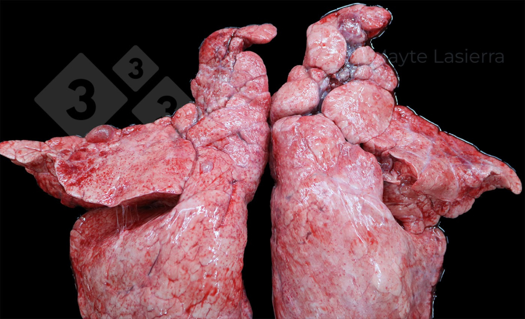 Zapalenie opłucnej doczaszkowej
