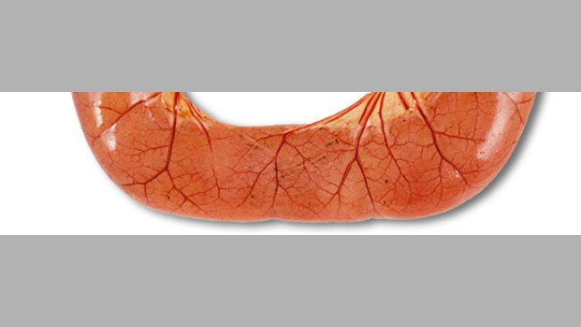 W badaniu sekcyjnym przypadków biegunki ETEC przeważnie stwierdza się rozszerzone, przekrwione pętle jelita cienkiego wypełnione wodnistą żółtą treścią